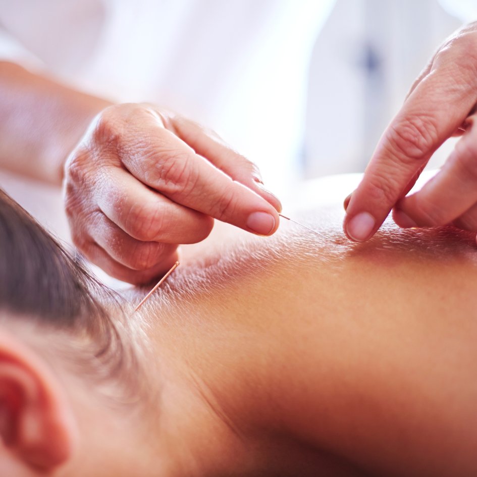 Dry Needling treatment